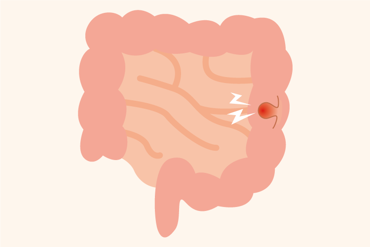大腸ポリープのイメージイラスト